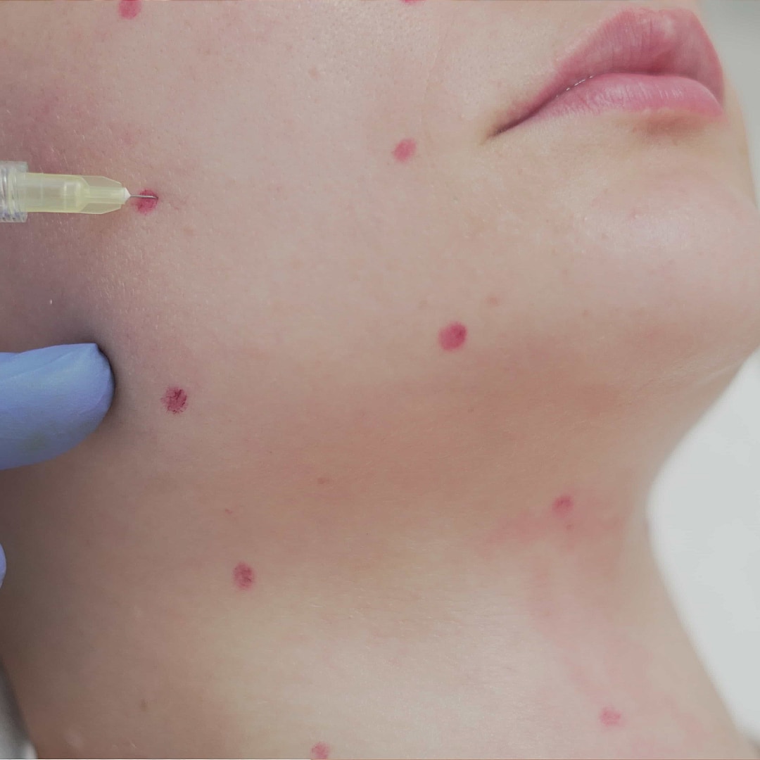 Fibrocell Treatment - Lifeplus Nisantasi