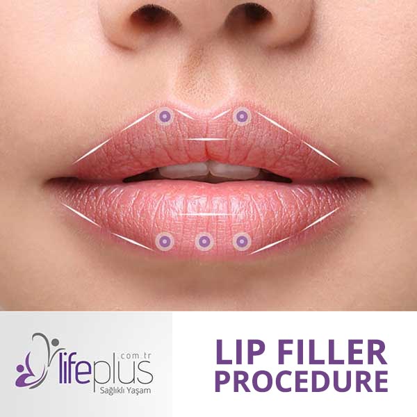 Lip Filling - Lifeplus Nisantasi