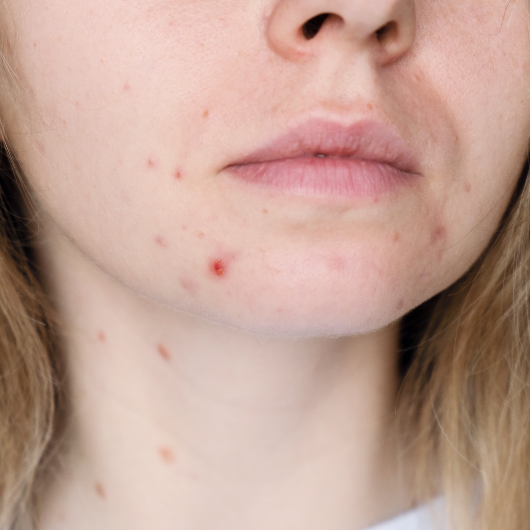Acne Scar Treatment - Lifeplus | Nişantaşı
