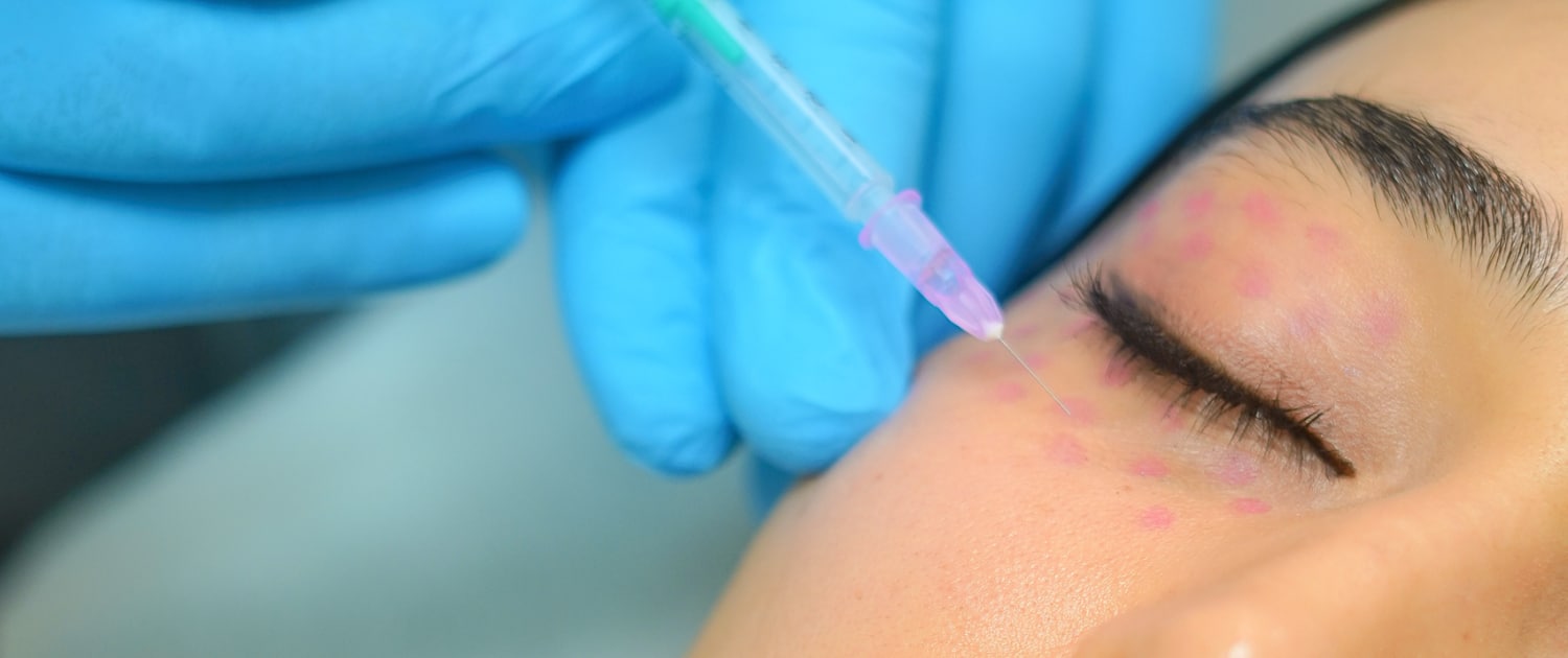 Collagen stimulators containing PDLLA and HA - Lifeplus | Nisantasi