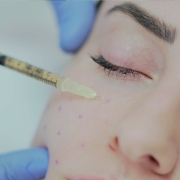 Yüz PRP - Dr. Ahmet KaraçamNişantaşı