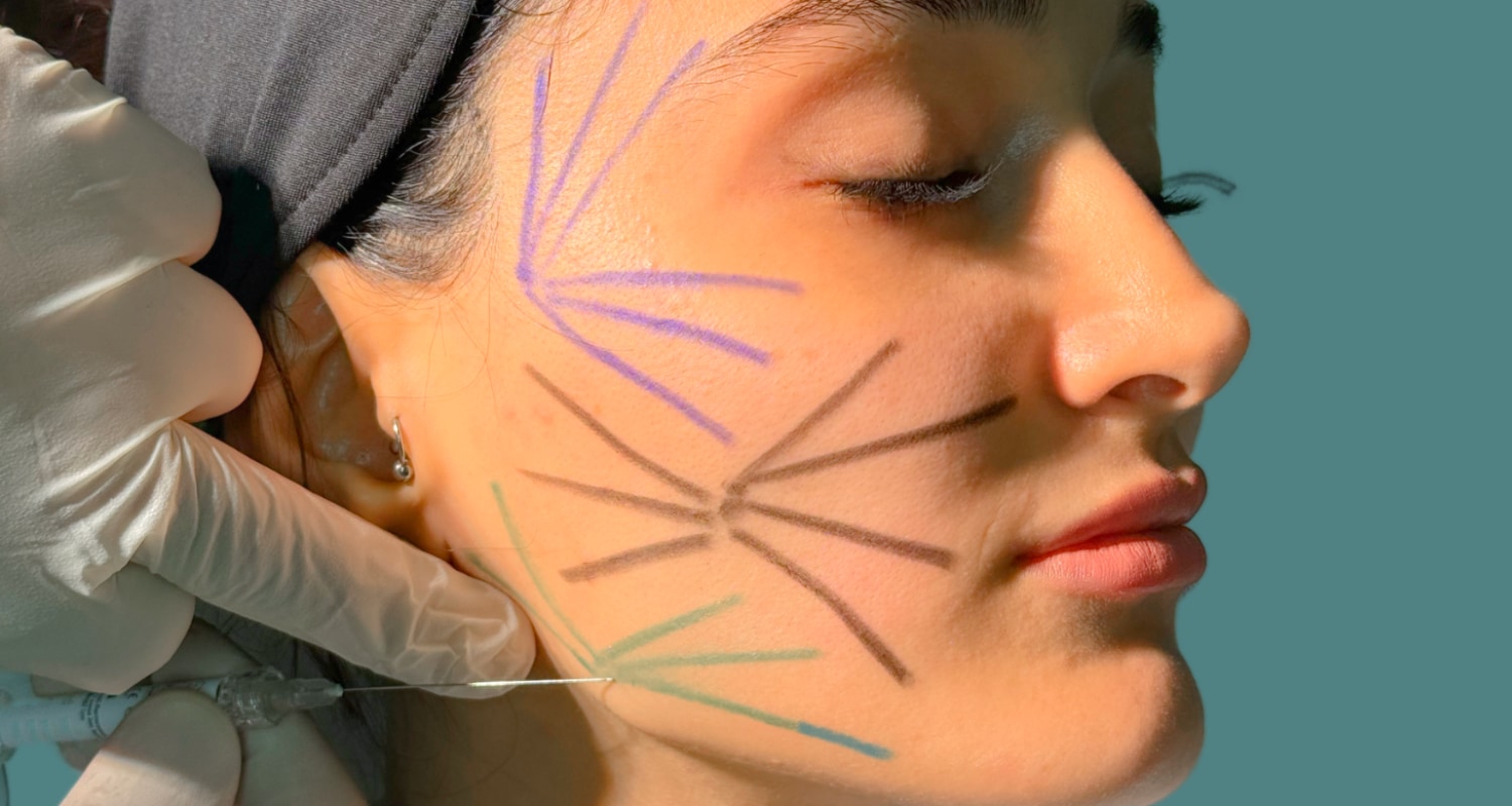 Sıvı Yüz Germe Nedir? Kimler İçin Uygundur ve Nasıl Yapılır? - Dr. Ahmet Karaçam | Nişantaşı