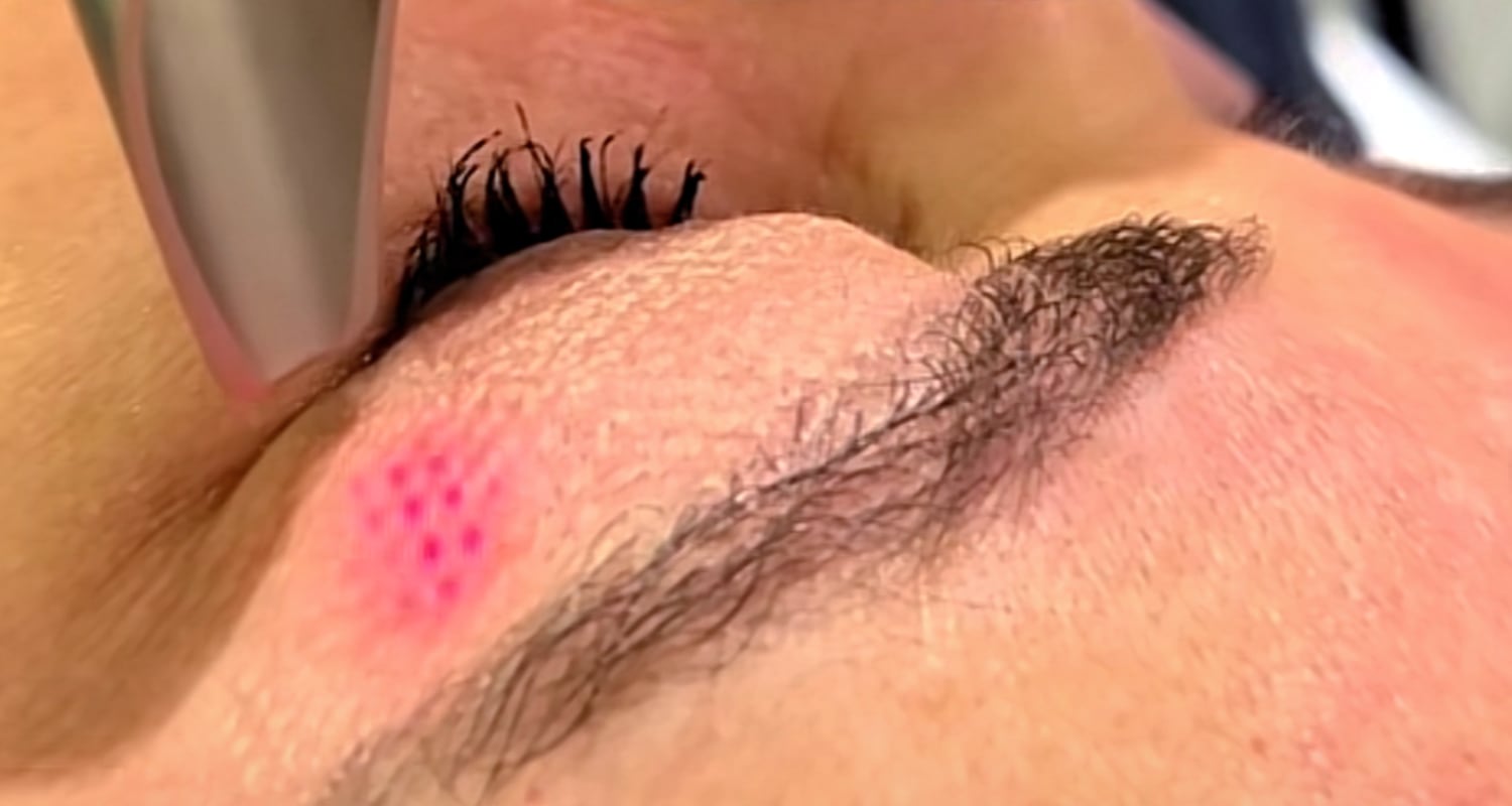 Smooth Eye ile Ameliyatsız Göz Çevresi Gençleştirme - Dr. Ahmet Karaçam | Nişantaşı